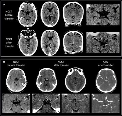 CT after interhospital transfer in acute ischemic stroke: Imaging findings and impact of prior intravenous contrast administration